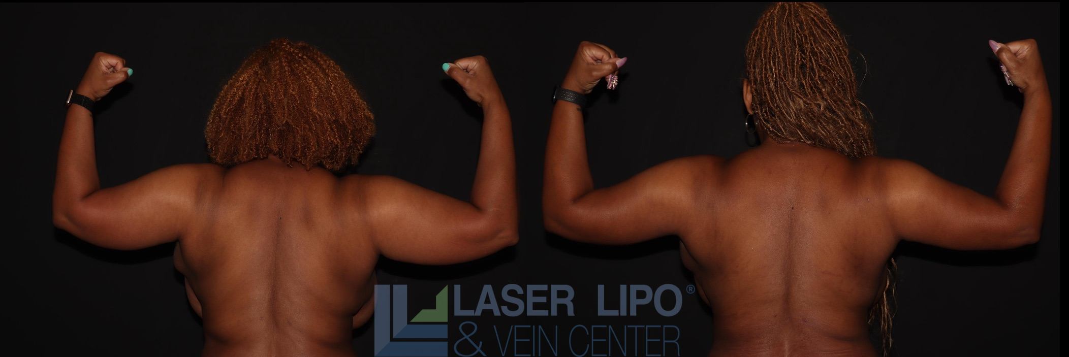 Before and After Image: Liposuction – Arms - back